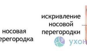 Искривление перегородки носа: причины, последствия, операция и лечение