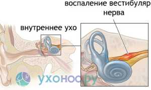 Неврит слухового нерва: причины, признаки, как лечить и предотвратить