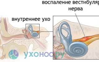Неврит слухового нерва: причины, признаки, как лечить и предотвратить