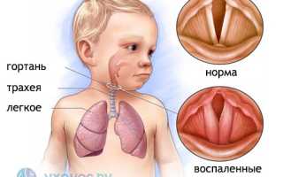 Осиплость: факторы возникновения, обзор причин, чем и как лечить, рекомендации специалистов