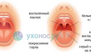 Опухло горло: механизм развития, причины, проявления, диагностика, терапия и рекомендации