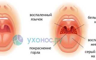 Опухло горло: механизм развития, причины, проявления, диагностика, терапия и рекомендации