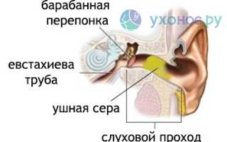 Пробки в ушах: как удалить в домашних условиях и у врача, советы и рекомендации