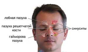 Фронтит: как развивается, проявления, диагностика, тактика лечения и профилактика