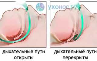 Храп: причины и развитие, проявления и особенности, методы лечения и профилактики