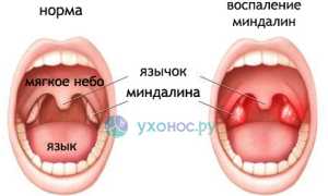 Промывание миндалин: суть процедуры, показания, способы, можно ли дома и как это сделать правильно
