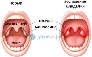 Промывание миндалин: суть процедуры, показания, способы, можно ли дома и как это сделать правильно