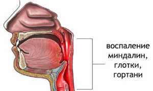 Парагрипп: причины, признаки, диагностика, как лечить и профилактика заболеваний