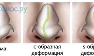 Операции по исправлению перегородки носа: хирургическая, лазером и их особенности
