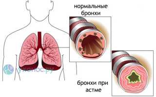 Бронхиальная астма: причины и как развивается, признаки и выявление, лечение, профилактика для здоровья