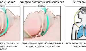 Апноэ (остановка дыхания во сне): как развивается у детей и взрослых, признаки и проявления, диагностика, лечение, советы специалистов