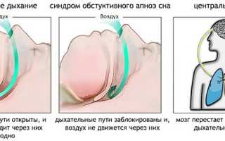 Апноэ (остановка дыхания во сне): как развивается у детей и взрослых, признаки и проявления, диагностика, лечение, советы специалистов