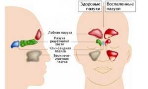 Киста в носовой пазухе: причины и развитие, признаки и течение, диагностика, как лечить, важные рекомендации