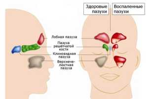 Киста в носовой пазухе: причины и развитие, признаки и течение, диагностика, как лечить, важные рекомендации