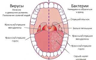 Дерет горло: причины/симптомы, что делать, как лечить, полезные советы