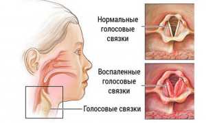 Сел голос: почему это происходит, как протекает, лечение и средства, советы специалистов