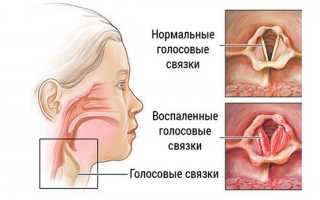 Сел голос: почему это происходит, как протекает, лечение и средства, советы специалистов