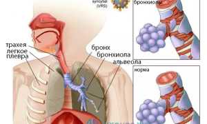 Бронхиолит: причины, проявления, диагноз, лечение, профилактика и советы по уходу