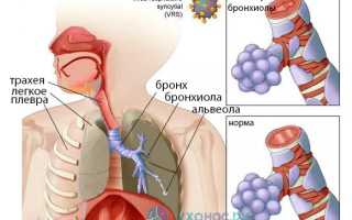 Бронхиолит: причины, проявления, диагноз, лечение, профилактика и советы по уходу
