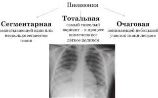 Сегментарная пневмония: этиология, проявления, диагностика, лечение и профилактика