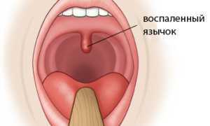 Отек, опух, воспалился язычок в горле (увулит): причины, лечение и рекомендации