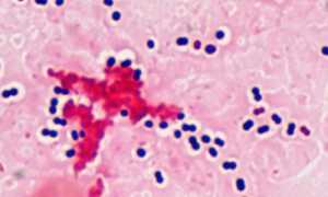 Streptococcus pneumoniae: характеристика, патогенность, диагностика, лечение и профилактика