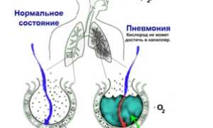 Левосторонняя пневмония: развитие, симптоматика, диагностика, терапия и профилактика