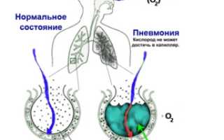 Левосторонняя пневмония: развитие, симптоматика, диагностика, терапия и профилактика