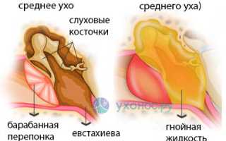 Течет из уха: причины, виды и характер выделений, диагностика, лечение, советы специалистов