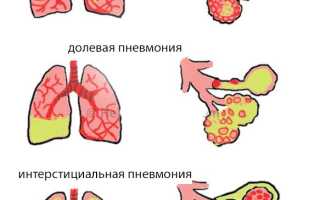 Двусторонняя пневмония: развитие и особенности, симптомы, диагностика, лечение и профилактика