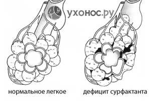 Респираторный дистресс-синдром (РДС): причины и как развивается, симптоматика, лечение и профилактика