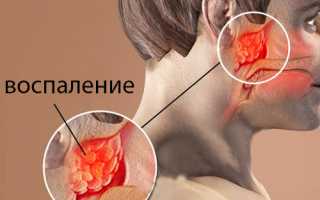 Аденоидный тип лица: причины, признаки, диагностика, как исправить, профилактика и рекомендации