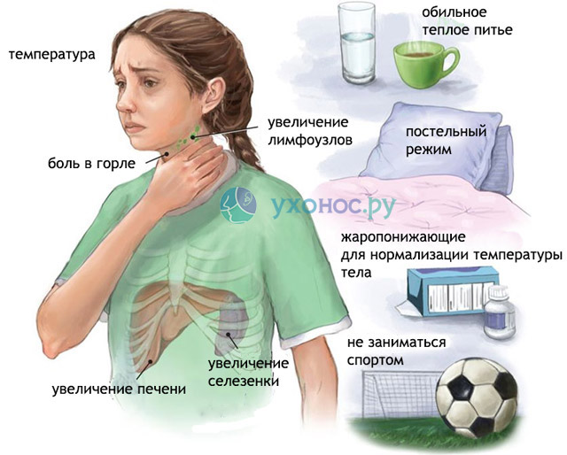 Мононуклеоз: симптомы и лечение