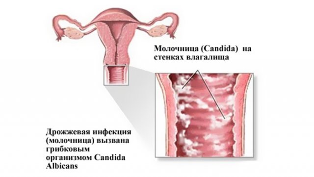 молочница у беременных