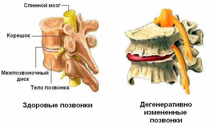 Дегенеративно измененные позвонки Дегенеративно измененные позвонки