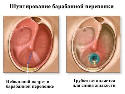 Как проводится шунтирование барабанной перепонки