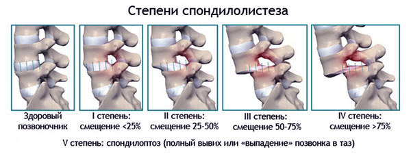 Смещение седьмого позвонка смещение шейных позвонков симптомы