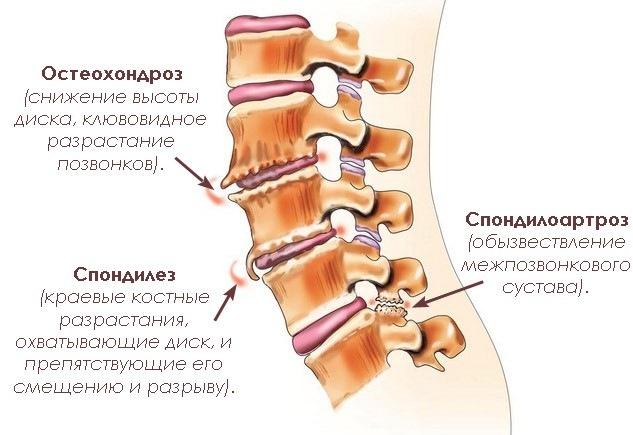 Возможные осложнения и профилактика чем лечить корешковый синдром позвоночника