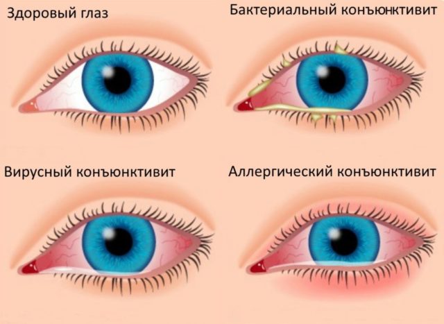 Сравнение видов конъюнктивита