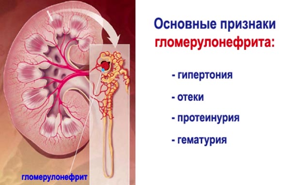 осложнения скарлатины