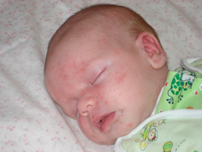 Диатез у ребенка - симптомы, этапы протекания и лечение аллергического дерматита у детей (130 фото)