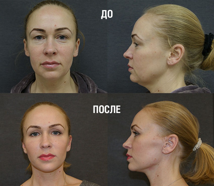 Подтяжка лица: плюсы, минусы, пошаговое описание процедуры и современные виды подтяжек (115 фото)