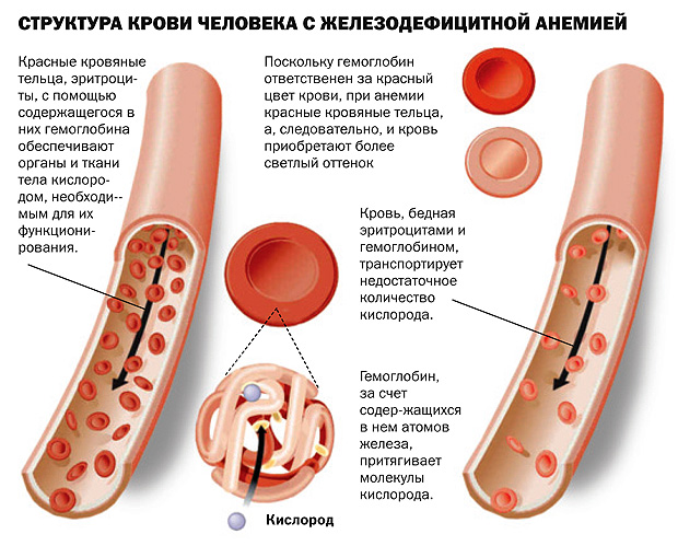 апластическая анемия