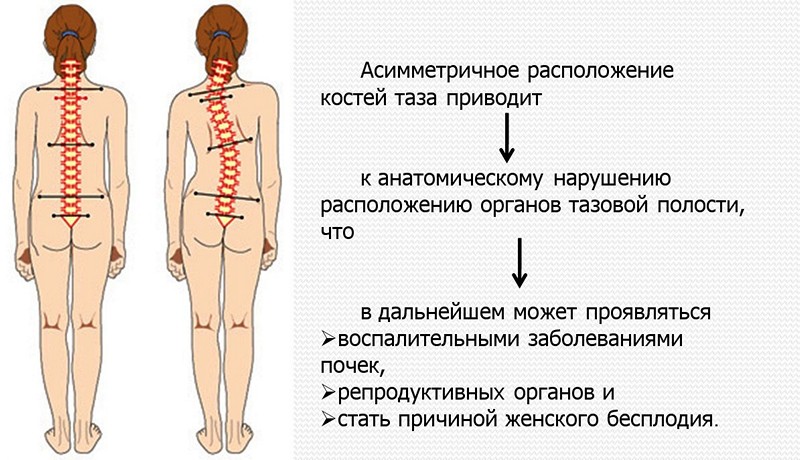 Нарушение осанки у детей