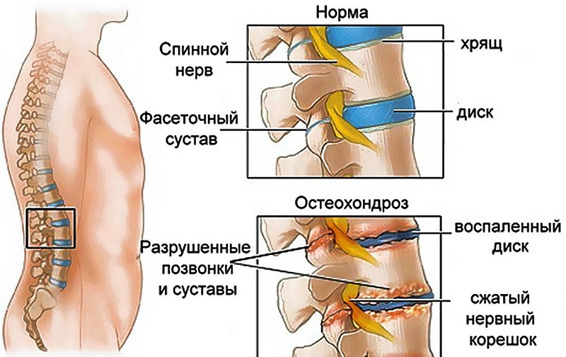 Симптомы и лечение корешкового синдрома поясничного отдела