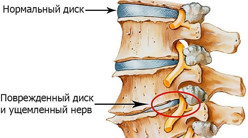 Люмбаго зачастую сопровождается невралгией седалищного нерва что такое люмбаго