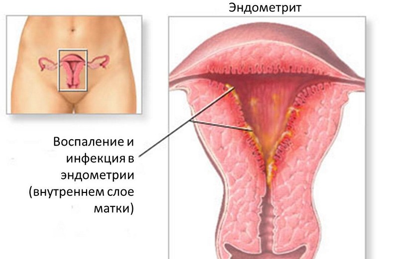 Эндометриоз Эндометриоз