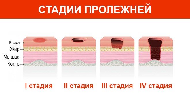 стадии пролежней