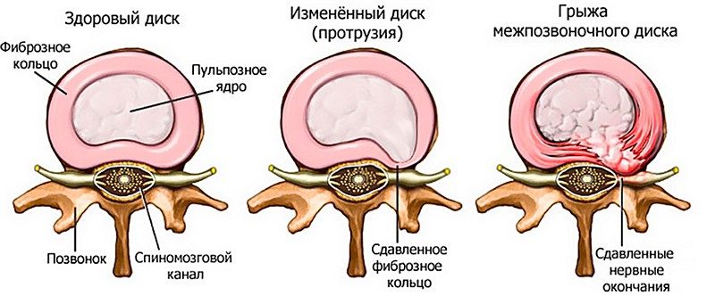 Межпозвоночная грыжа Межпозвоночная грыжа