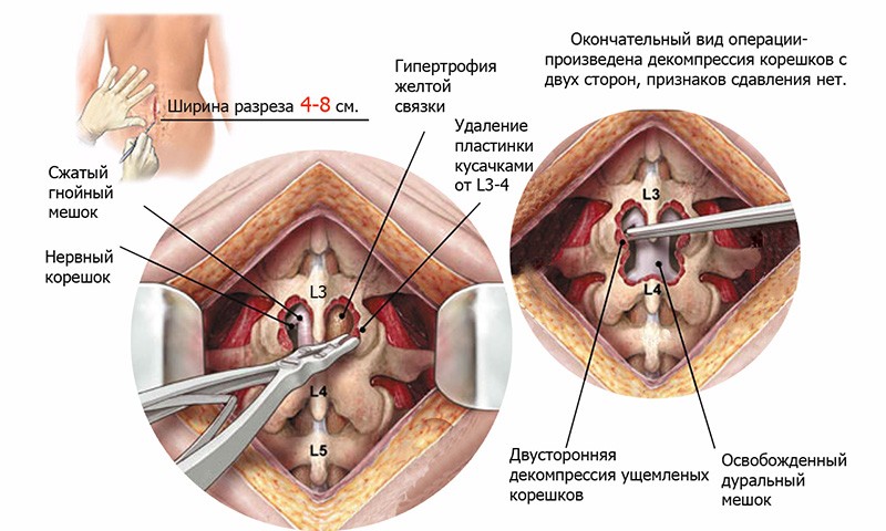 gryzha-pozvonochnika-microdiskektomia